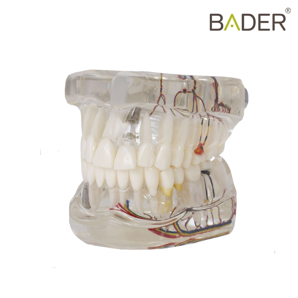 MODELO DENTAL DE IMPLANTE CON NERVIO