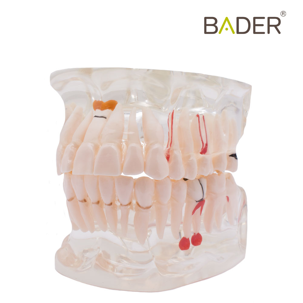 MODELO DENTAL TRANSPARENTE IMPLANTE