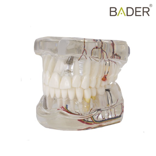 [0905111] MODELO DENTAL DE IMPLANTE CON NERVIO