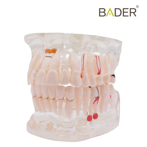 [0905114] MODELO DENTAL TRANSPARENTE IMPLANTE