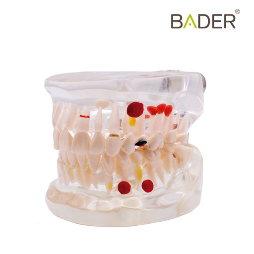 [0905115] MODELO DENTAL TRANSPARENTE CARIES